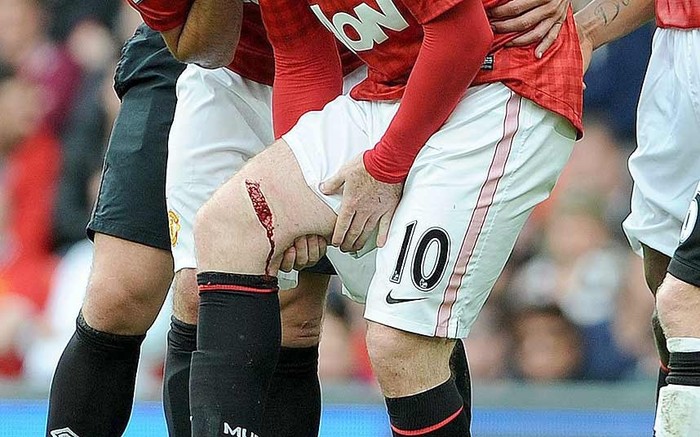 Vết rách trên đùi của Rooney khá sâu và dự kiến anh sẽ phải nghỉ thi đấu hết tháng 10...